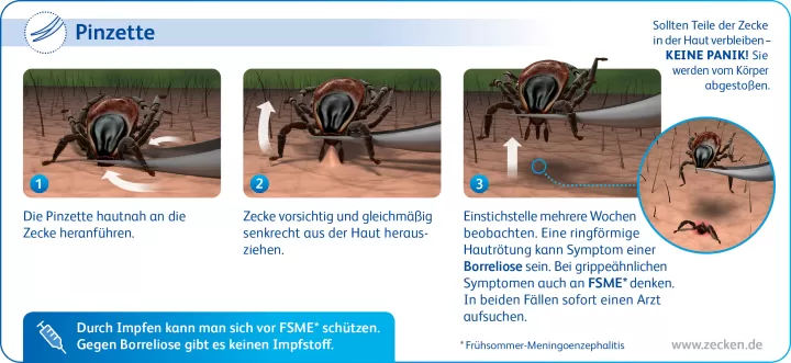 Zeckenentfernung mit der Pinzette